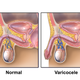 Illustration for article titled Obat Varikokel Yang Ampuh